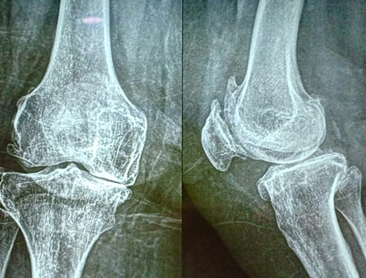 Total Knee Replacement