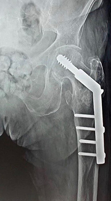 Dynamic Hip Screw