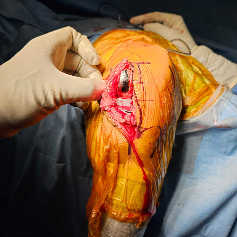 Exposure required for partial knee replacement