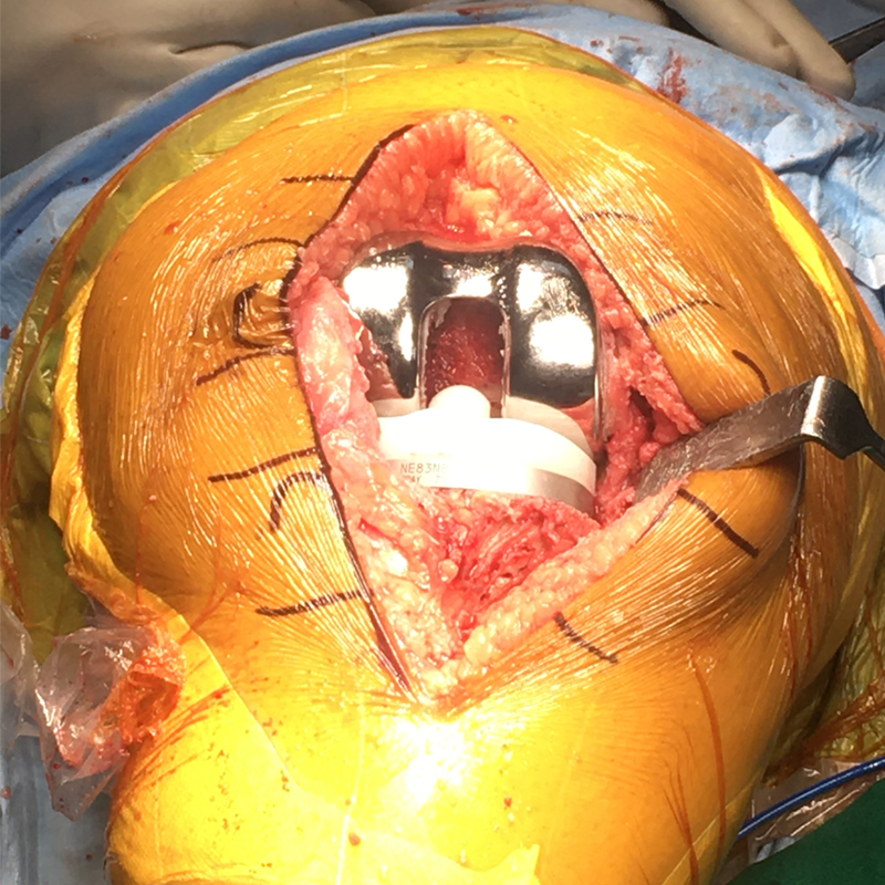 Exposure required for total knee replacement