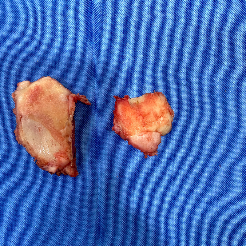 Bone removed for partial knee replacement
