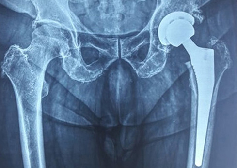 Total Hip Replacement