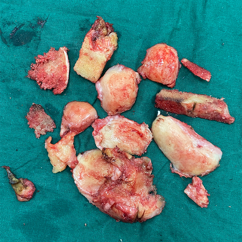 Bone removed for total knee replacement
